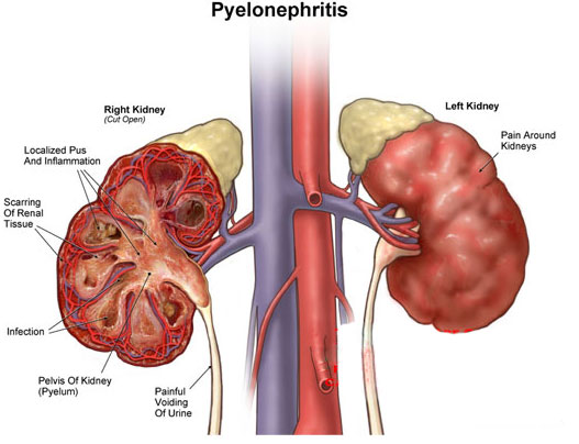 polinephrytis-web-foto